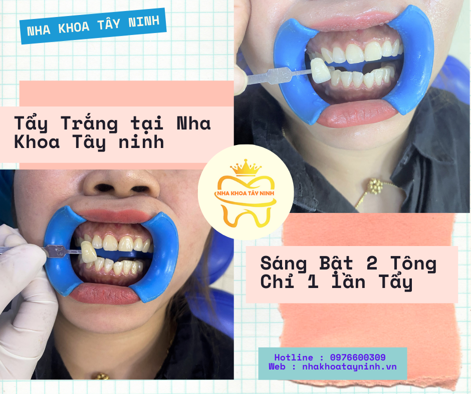 Tẩy trắng răng tại Nha Khoa Tây Ninh