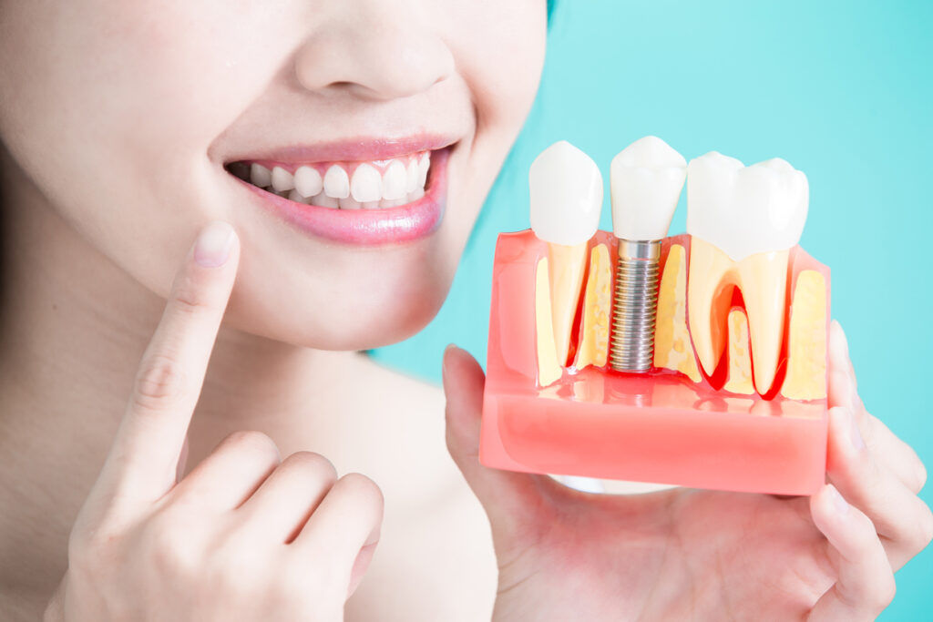 Cấy ghép Implant tại Nha Khoa Tây Ninh
