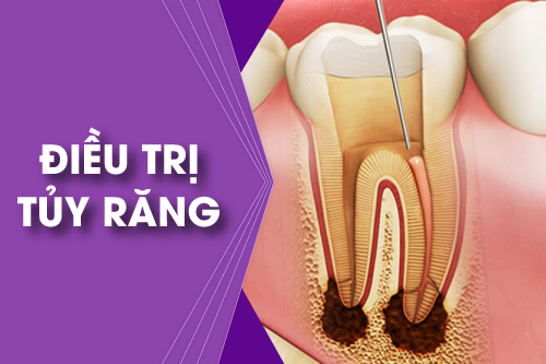 Dịch vụ điều trị tủy răng tại Tây Ninh