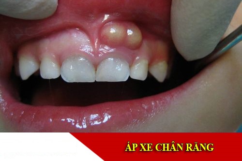 điều trị áp xe chân răng