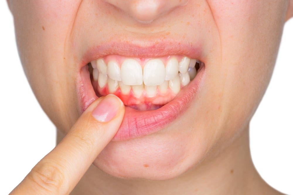 điều trị viêm nha chu