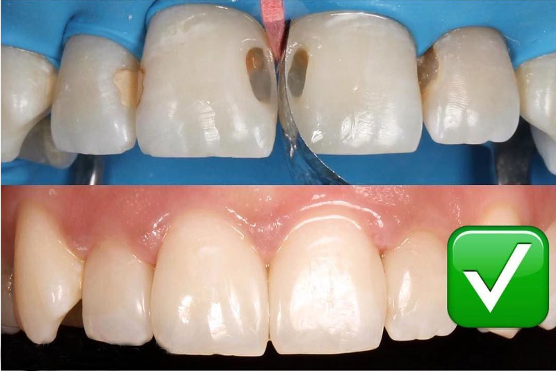 Dịch vụ trám răng tại Nha khoa Tây Ninh