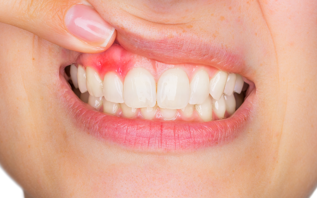 Điều trị bệnh viêm nứu tại Tây Ninh