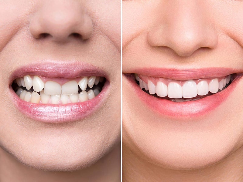 Bọc răng sứ tại Nha khoa Tây Ninh chuyên nghiệp, uy tín