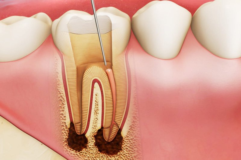 Chữa tủy răng số 6