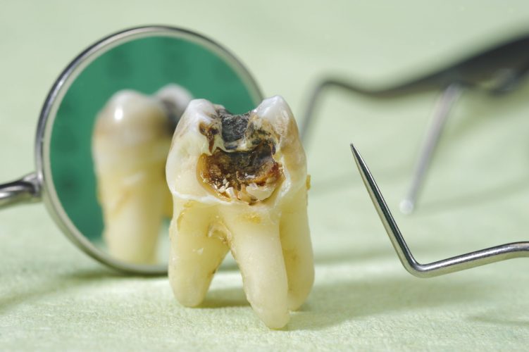 Dịch vụ nhổ răng sâu tại Nha khoa Tây Ninh
