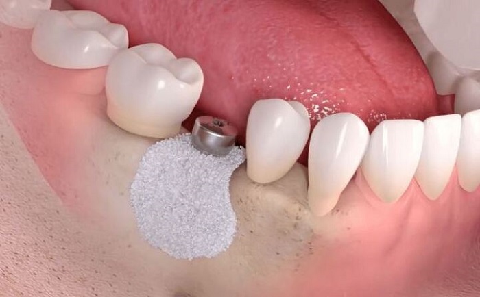 Ghép xương răng tại Nha khoa Tây Ninh