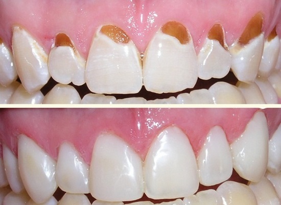 Hàn răng Composite tại Nha khoa Tây Ninh