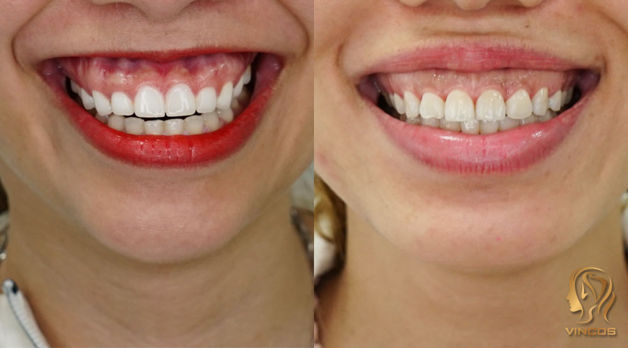 Điều trị cười hở lợi tại Nha khoa Tây Ninh