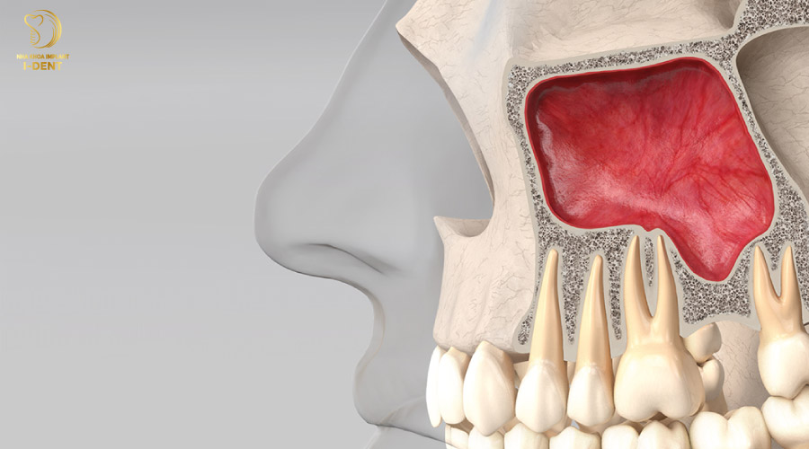 Nâng xoang kín khi cấy ghép Implant