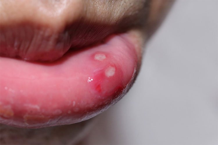 Điều trị nhiệt miệng