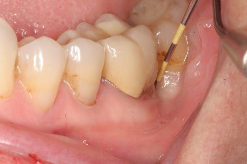 Quy trình điều trị viêm chân răng tại Nha khoa Tây Ninh