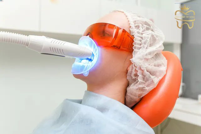 Tẩy trắng răng bằng Laser