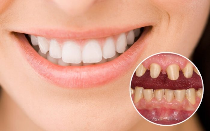Trồng răng sứ giá rẻ tại Nha khoa Tây Ninh